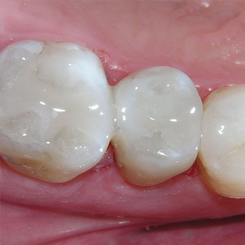 Composite Fillings