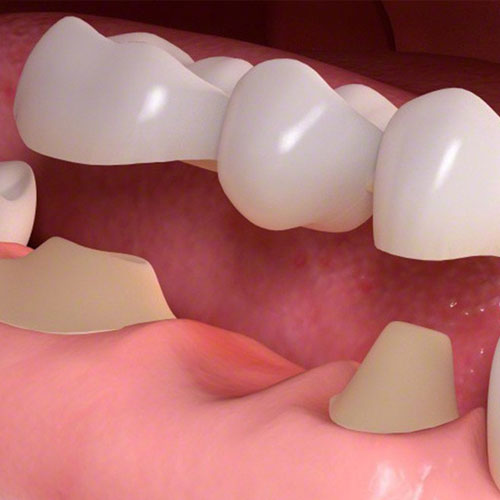 Dental Bridge