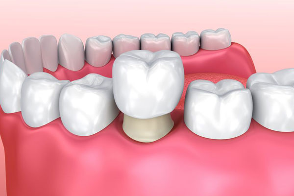 Dental Crowns TAS