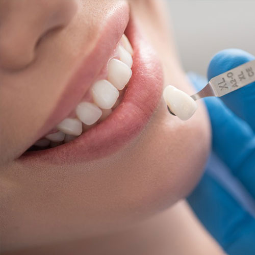 Dental Crowns