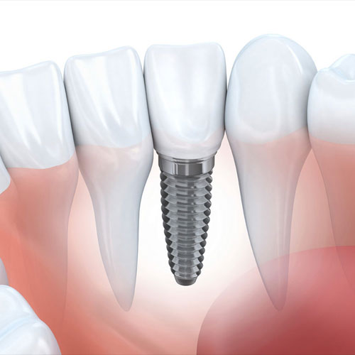 Dental Implants