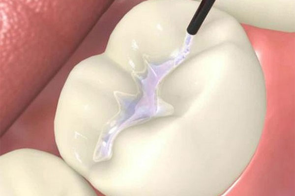 Dental Sealants
