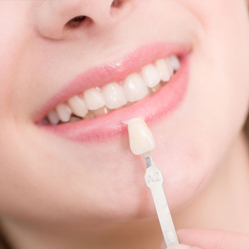 Dental Veneers