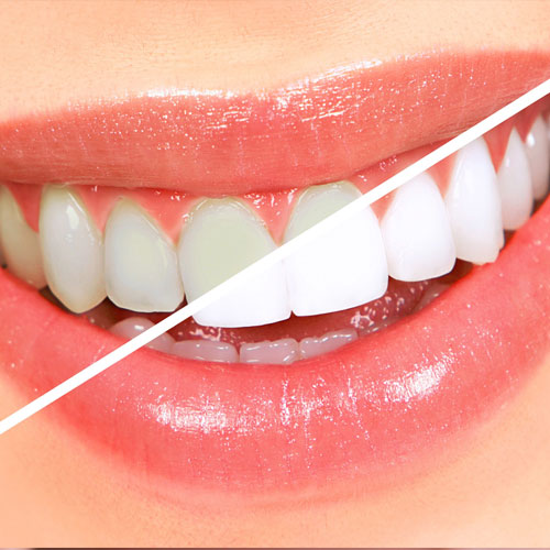 Teeth Whitening