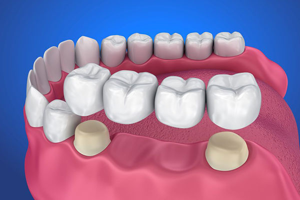 Dental Bridge Service