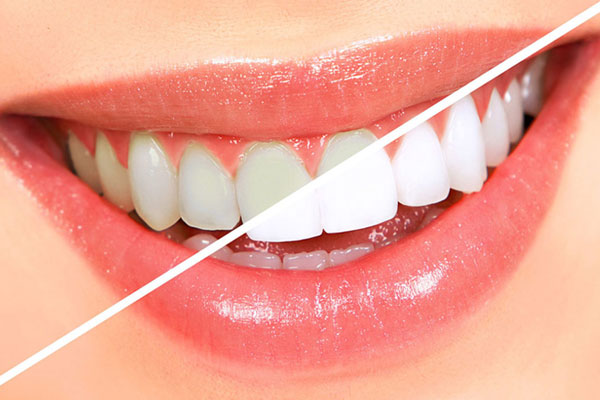 Teeth Whitening