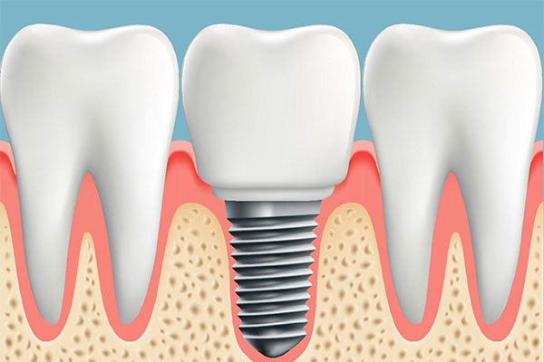 We offer Dental Implants service at our clinic
